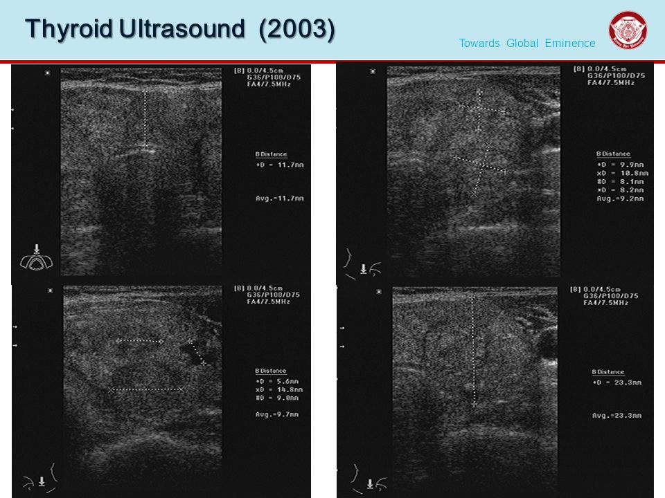 Towards Global Eminence K Y U N G H E E U N I V E R S I T Y Thyroid Ultrasound (2003)