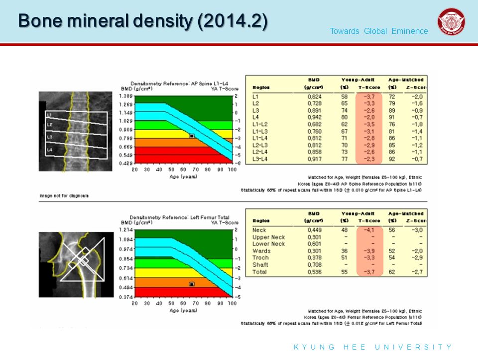 Towards Global Eminence K Y U N G H E E U N I V E R S I T Y Bone mineral density (2014.2)