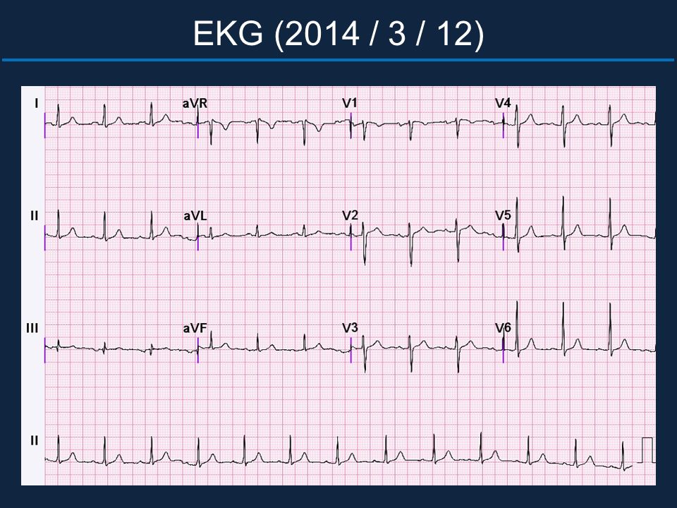 EKG (2014 / 3 / 12)