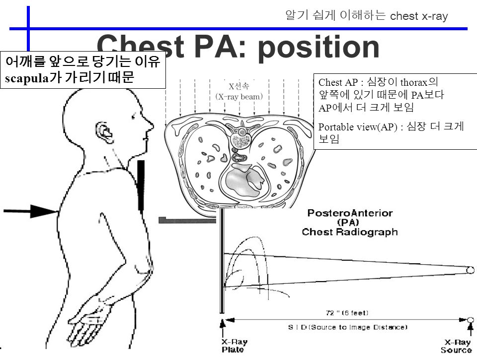 알기 쉽게 이해하는 chest x-ray Chest PA: position Chest AP : 심장이 thorax 의 앞쪽에 있기 때문에 PA 보다 AP 에서 더 크게 보임 Portable view(AP) : 심장 더 크게 보임 어깨를 앞으로 당기는 이유 scapula 가 가리기 때문