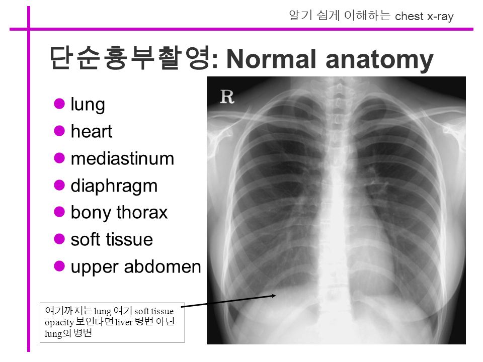 알기 쉽게 이해하는 chest x-ray 단순흉부촬영 : Normal anatomy lung heart mediastinum diaphragm bony thorax soft tissue upper abdomen 여기까지는 lung 여기 soft tissue opacity 보인다면 liver 병변 아닌 lung 의 병변