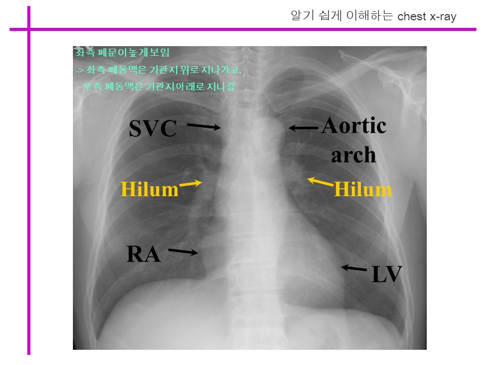 알기 쉽게 이해하는 chest x-ray SVC RA LV Aortic arch Hilum 좌측 폐문이 높게 보임 -> 좌측 폐동맥은 기관지 위로 지나가고, 우측 폐동맥은 기관지 아래로 지나감