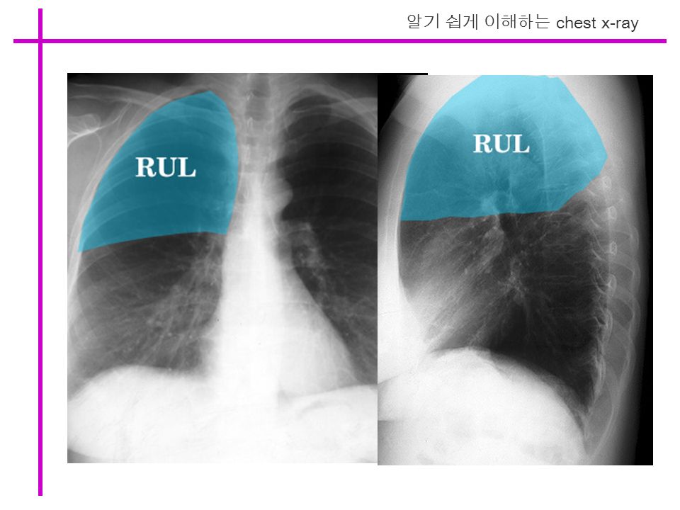 알기 쉽게 이해하는 chest x-ray
