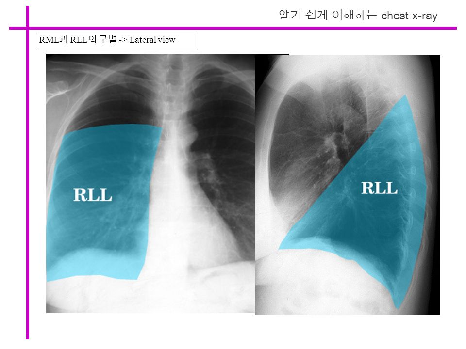 RML 과 RLL 의 구별 -> Lateral view