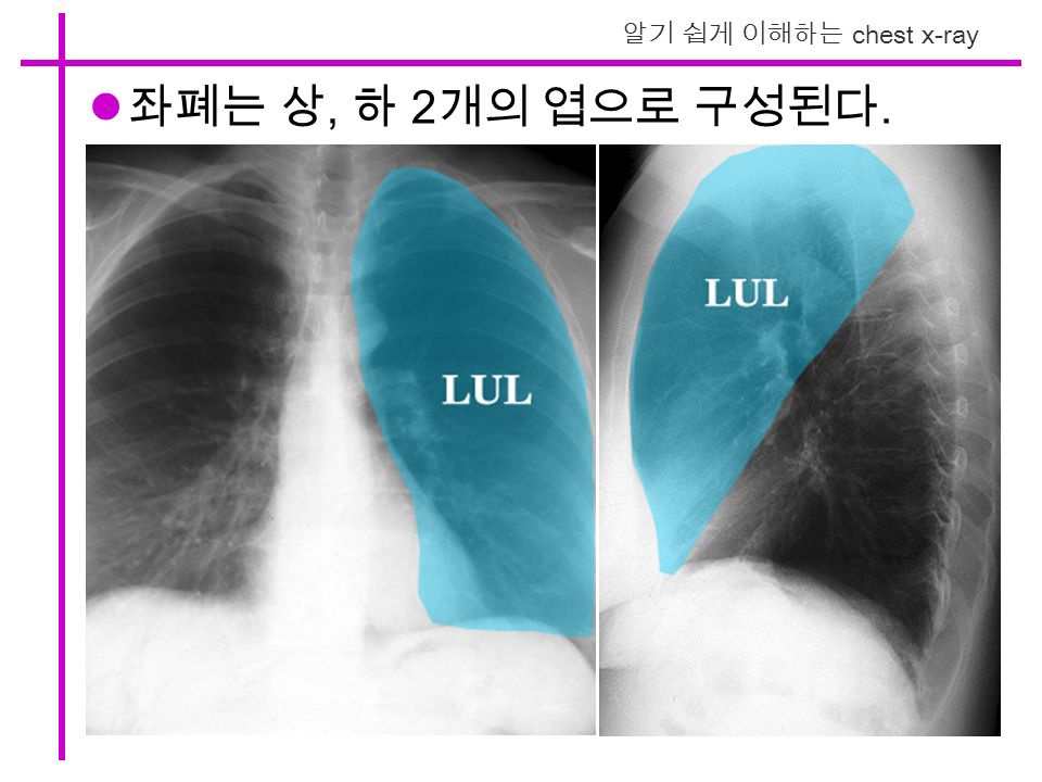 알기 쉽게 이해하는 chest x-ray 좌폐는 상, 하 2 개의 엽으로 구성된다.