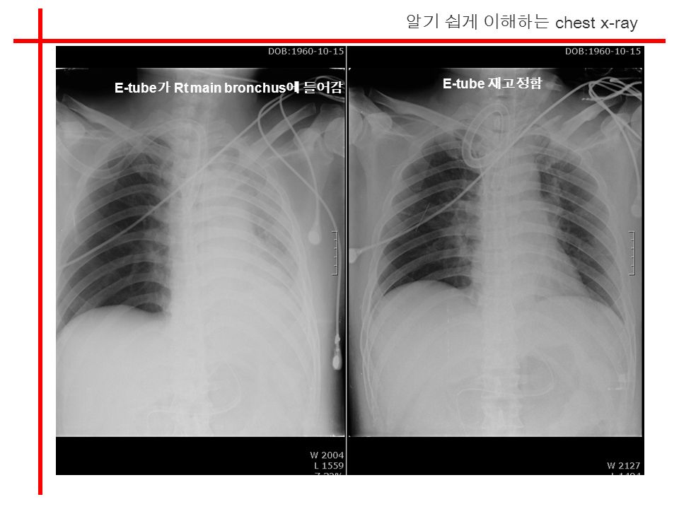 알기 쉽게 이해하는 chest x-ray E-tube 가 Rt main bronchus 에 들어감 E-tube 재고정함