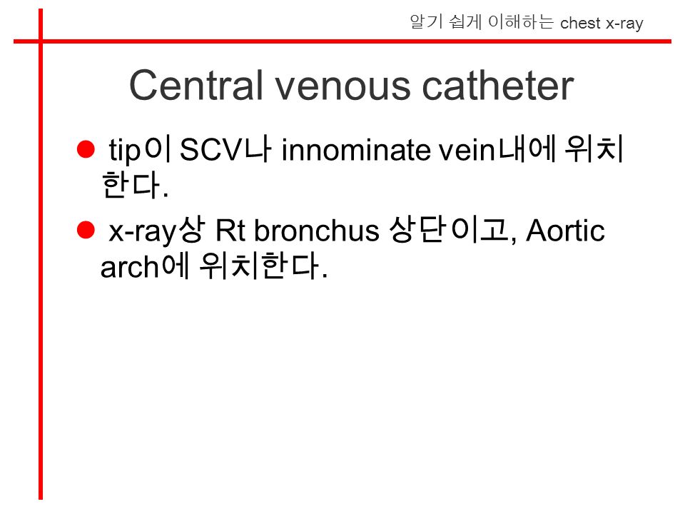 알기 쉽게 이해하는 chest x-ray Central venous catheter tip 이 SCV 나 innominate vein 내에 위치 한다.