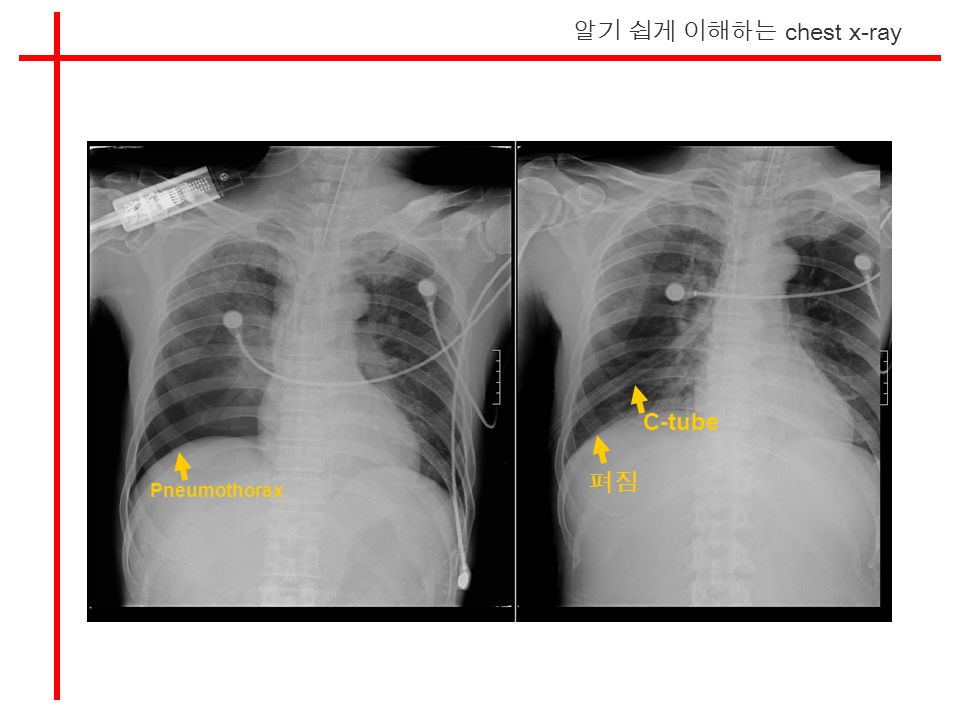 알기 쉽게 이해하는 chest x-ray Pneumothorax 펴짐 C-tube