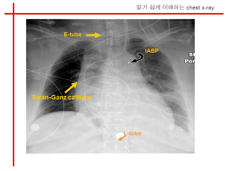 알기 쉽게 이해하는 chest x-ray Swan-Ganz catheter. E-tube IABP L-tube