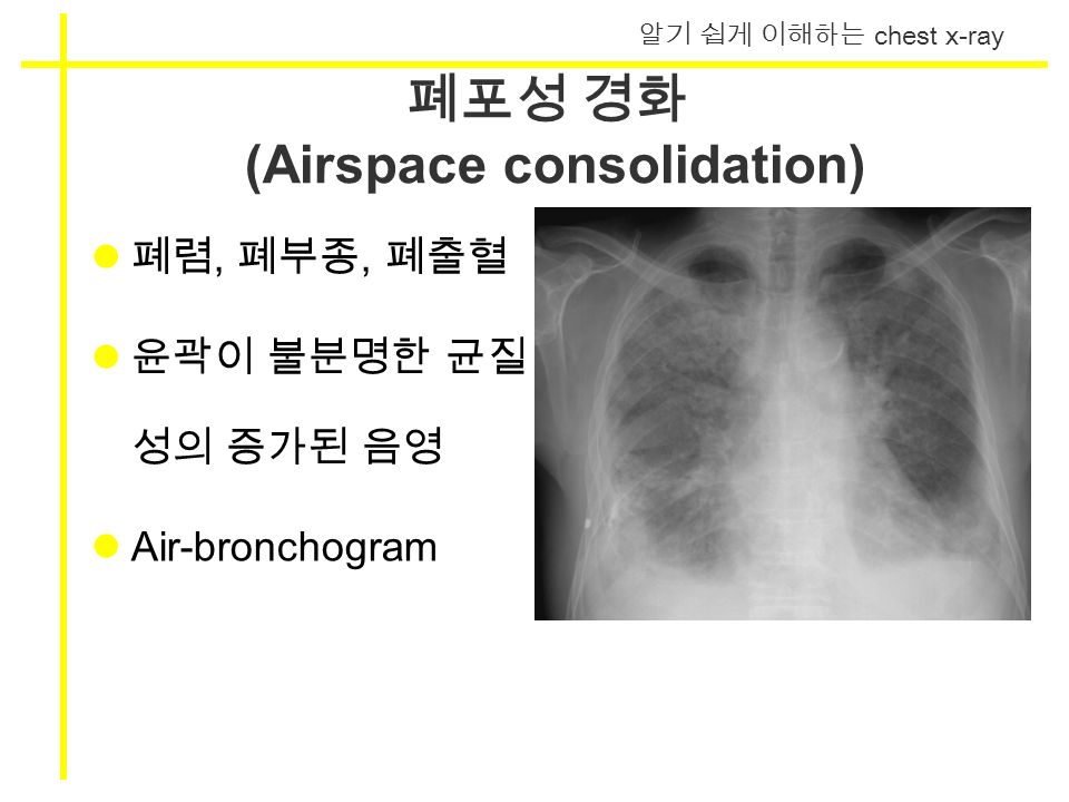 알기 쉽게 이해하는 chest x-ray 폐포성 경화 (Airspace consolidation) 폐렴, 폐부종, 폐출혈 윤곽이 불분명한 균질 성의 증가된 음영 Air-bronchogram