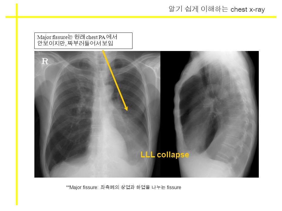 알기 쉽게 이해하는 chest x-ray Major fissure 는 원래 chest PA 에서 안보이지만, 짜부러들어서 보임 LLL collapse **Major fissure: 좌측폐의 상엽과 하엽을 나누는 fissure