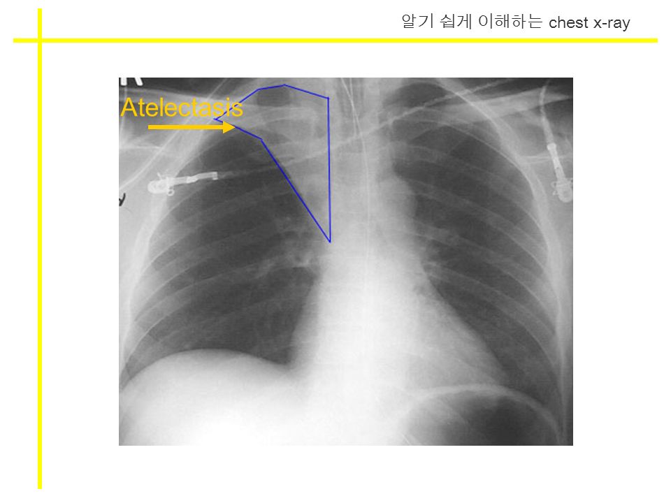 알기 쉽게 이해하는 chest x-ray Atelectasis