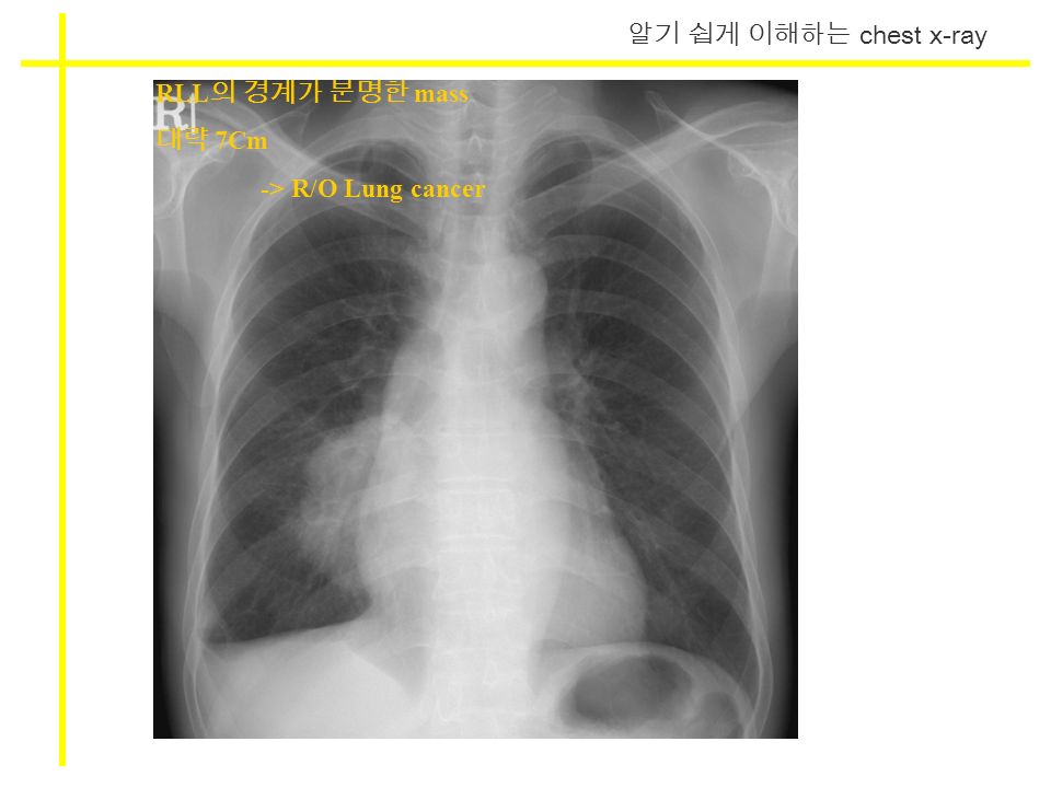 알기 쉽게 이해하는 chest x-ray RLL 의 경계가 분명한 mass 대략 7Cm -> R/O Lung cancer