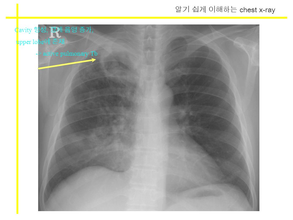 알기 쉽게 이해하는 chest x-ray Cavity 형성, 경계 음영 증가, upper lobe 에 존재 -> active pulmonary Tb