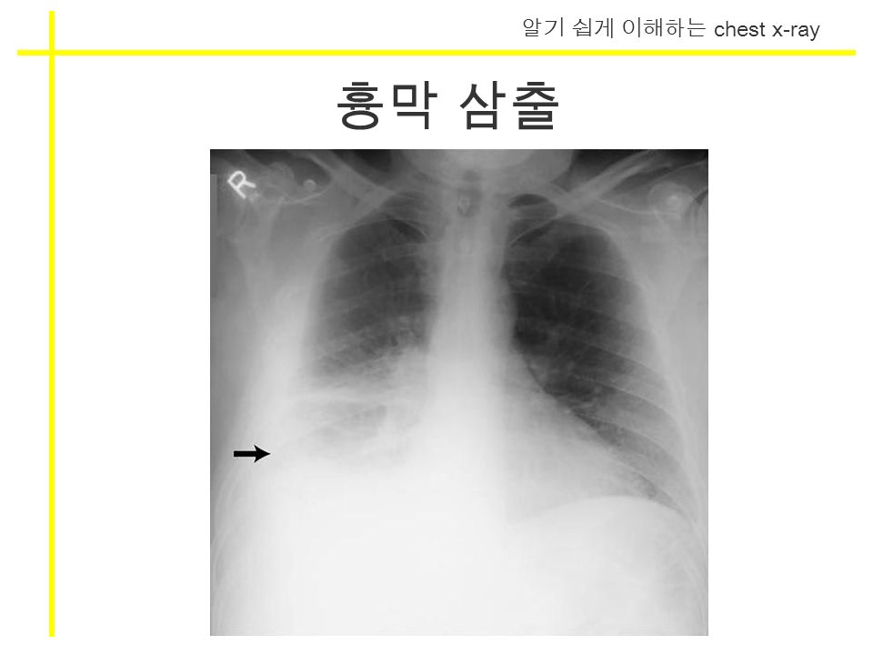 알기 쉽게 이해하는 chest x-ray 흉막 삼출
