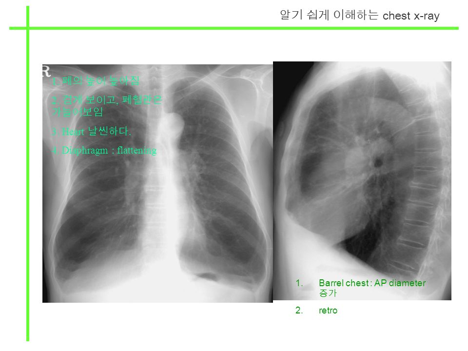 알기 쉽게 이해하는 chest x-ray 1. 폐의 높이 높아짐 2. 검게 보이고, 폐혈관은 가늘어보임 3.