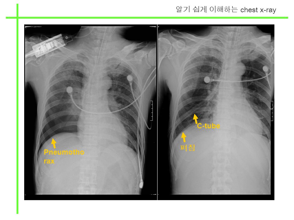알기 쉽게 이해하는 chest x-ray Pneumotho rax 펴짐 C-tube