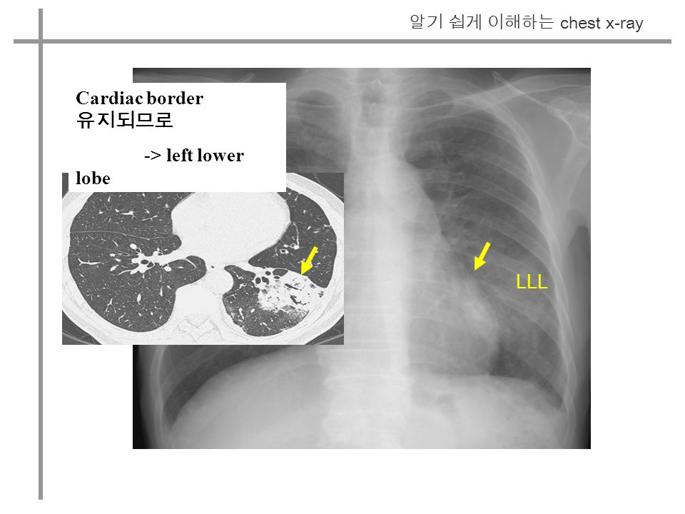 알기 쉽게 이해하는 chest x-ray Cardiac border 유지되므로 -> left lower lobe LLL