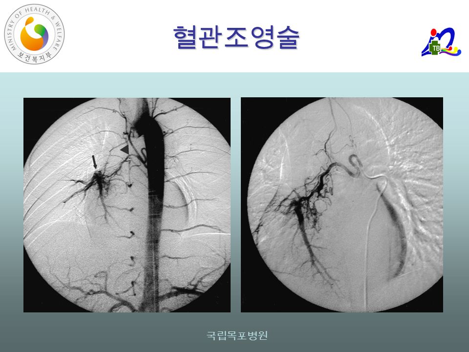 국립목포병원 혈관조영술