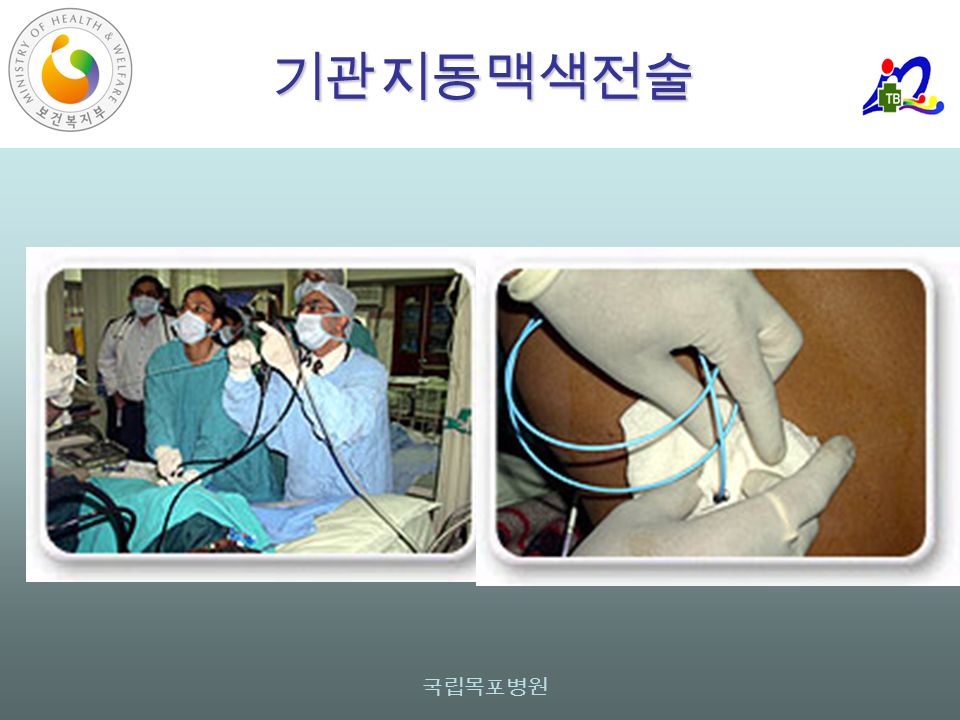 국립목포병원 기관지동맥색전술