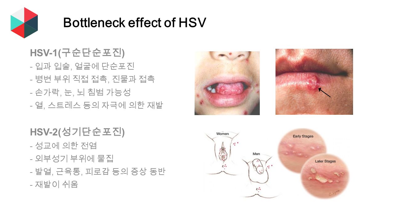 Bottleneck effect of HSV HSV-1( 구순단순포진 ) - 입과 입술, 얼굴에 단순포진 - 병변 부위 직접 접촉, 진물과 접촉 - 손가락, 눈, 뇌 침범 가능성 - 열, 스트레스 등의 자극에 의한 재발 HSV-2( 성기단순포진 ) - 성교에 의한 전염 - 외부성기 부위에 물집 - 발열, 근육통, 피로감 등의 증상 동반 - 재발이 쉬움