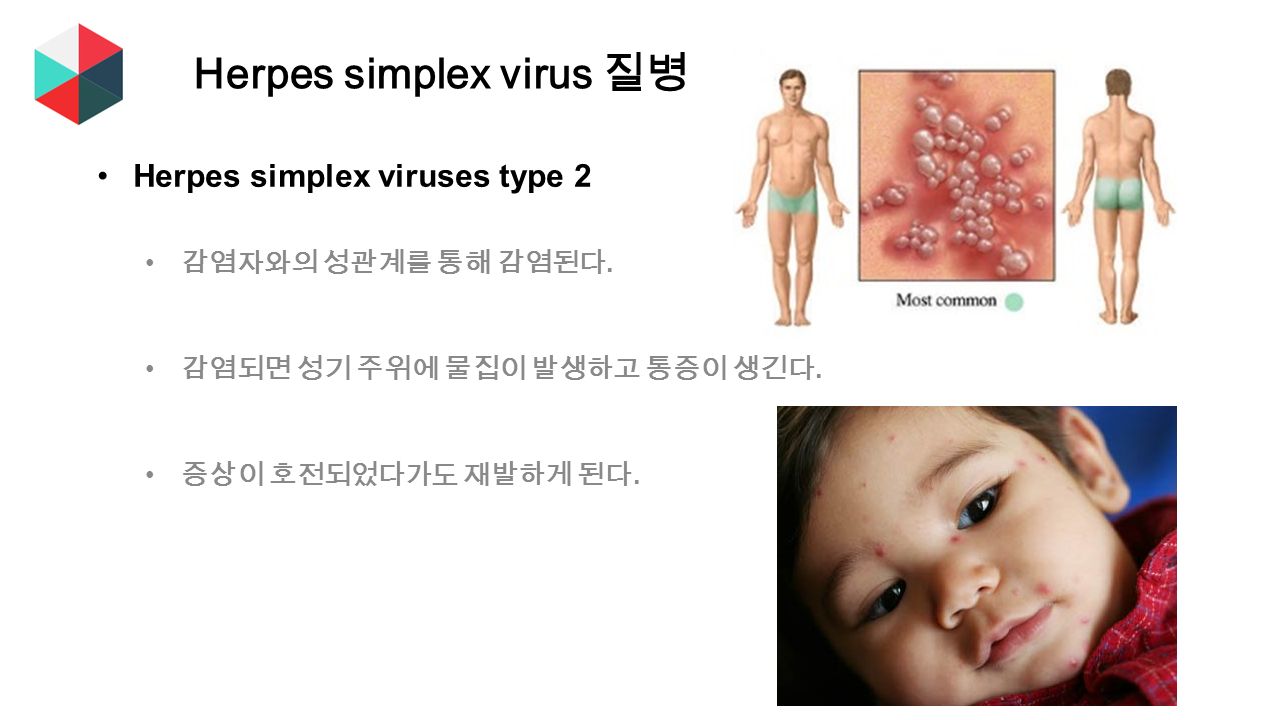 Herpes simplex viruses type 2 감염자와의 성관계를 통해 감염된다. 감염되면 성기 주위에 물집이 발생하고 통증이 생긴다.