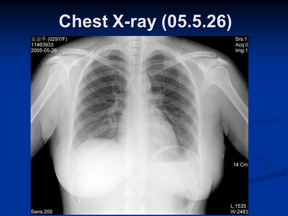 Chest X-ray ( )