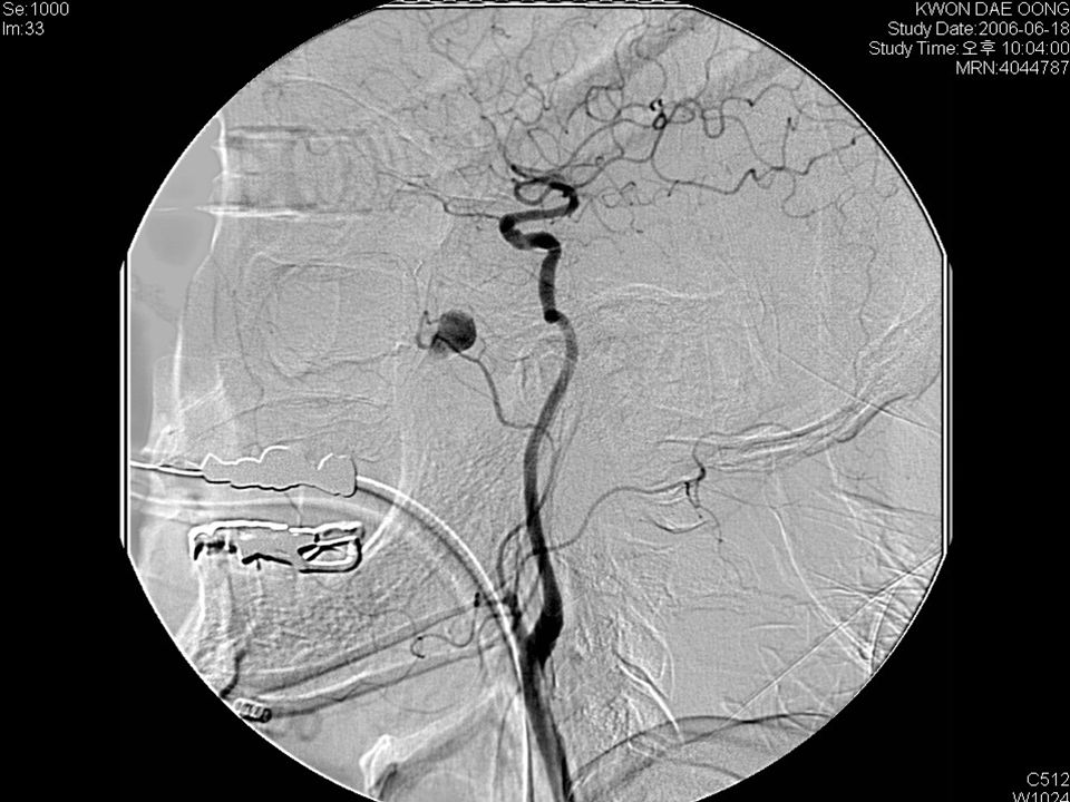 Progress (7)  Emergency angiography and embolism