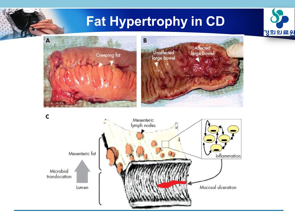Fat Hypertrophy in CD